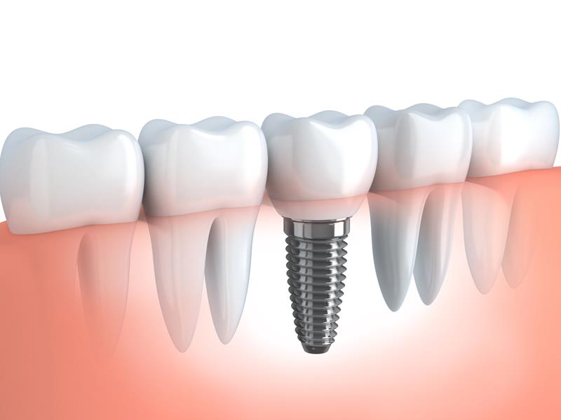 Dental Implants  Ashburn, VA 